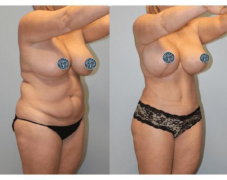 Tummy tuck transformation result