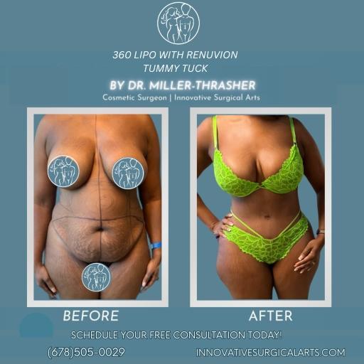 360 Lipo with Renuvion tummy tuck by Dr. Miller-Thrasher